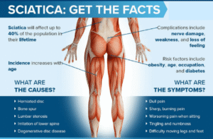 How Long Does Sciatica Last?
