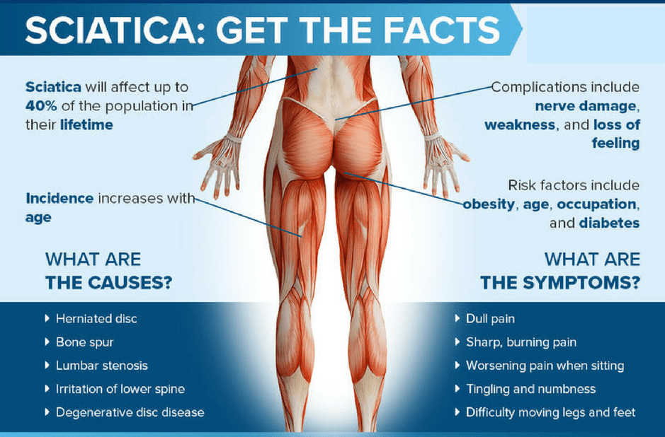 How Long Does Sciatica Last?